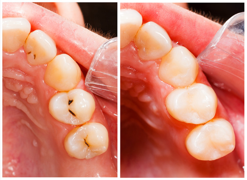 Dental Fillings Kelowna