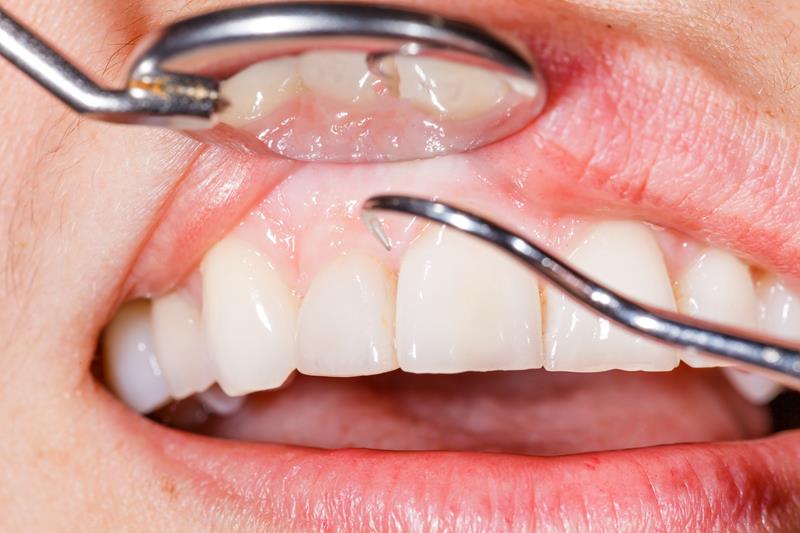 periodontal disease treatment in Kelowna
