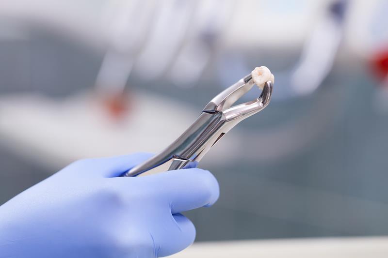 Tooth Extraction Kelowna