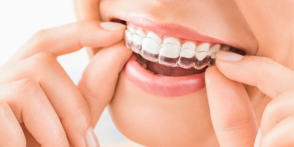 Invisalign Braces for Smile Makeover in Kelowna Family Dental