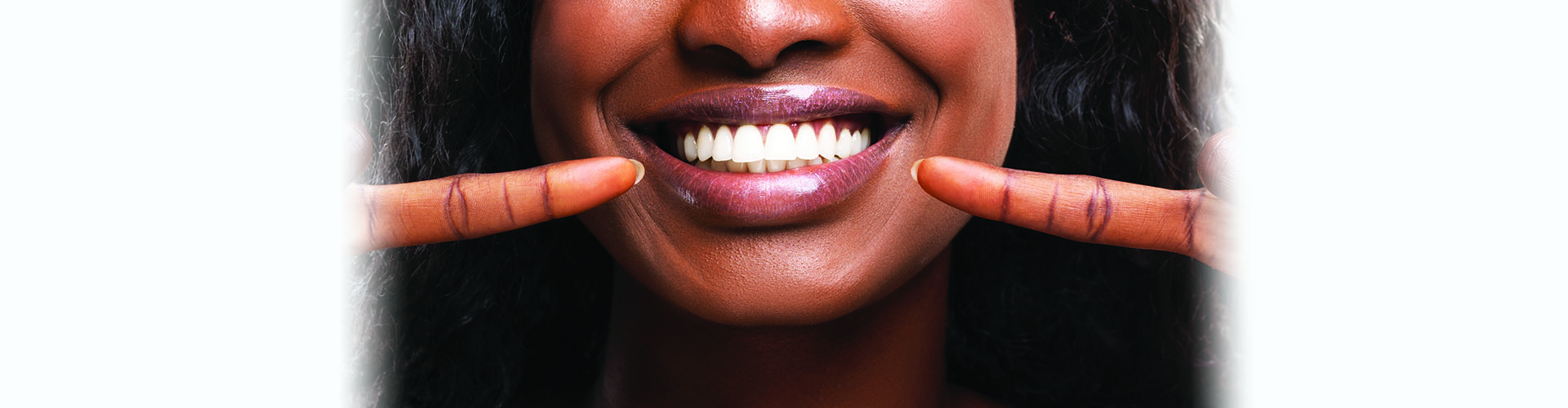 Teeth Whitening Procedure Kelowna