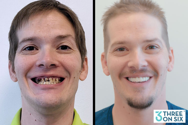 Dental Implant Surgery Kelowna Patient Results