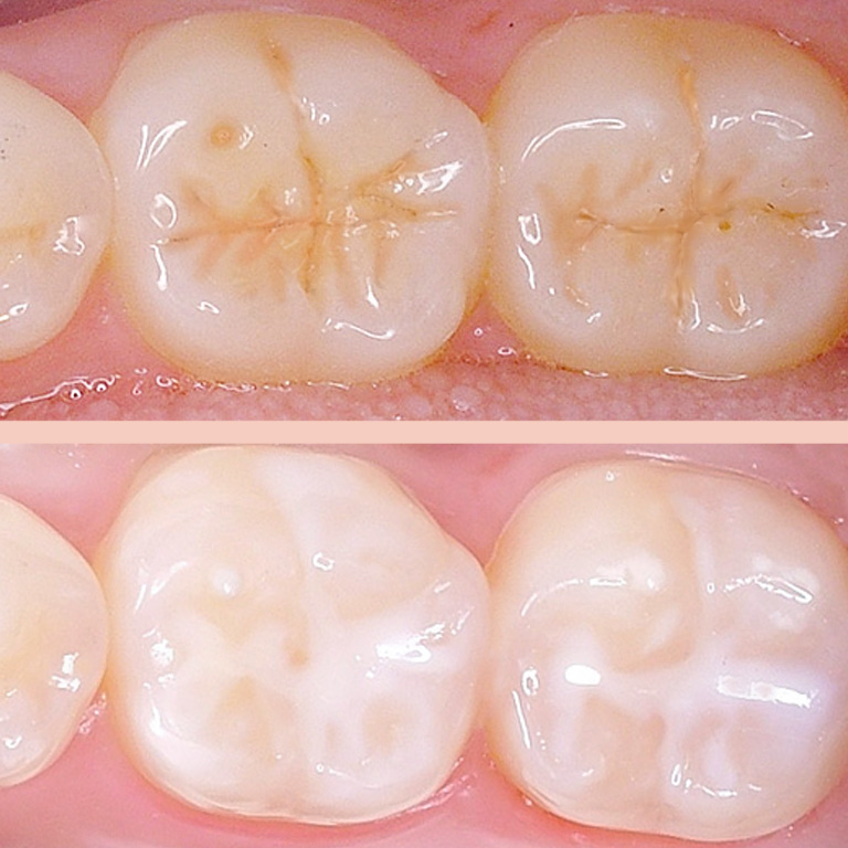 Dental Sealants Kelowna